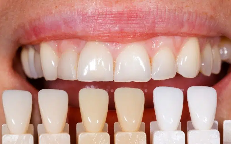 Veneers: Revolutionising Smile Functionality with Hidden Innovations
